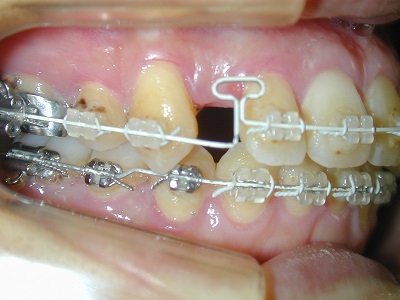 歯科矯正メカニクス -その普遍性と臨床応用- Ⅱ
